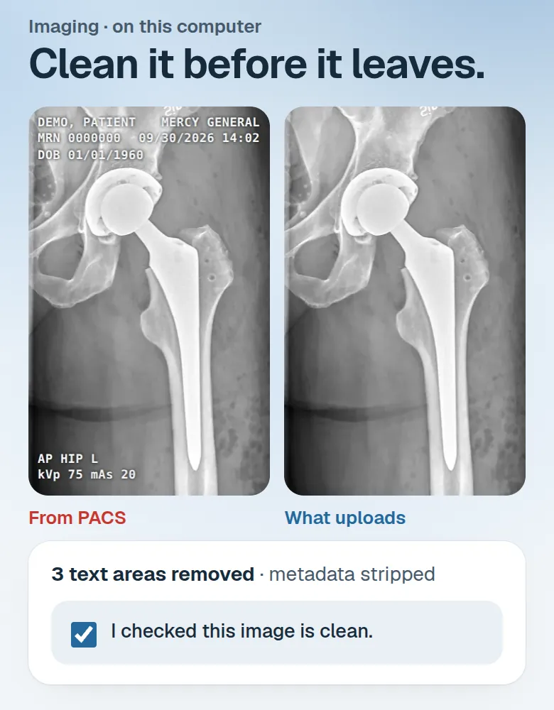 A hip X-ray before and after: burned-in name, MRN and dates removed on the computer before upload.