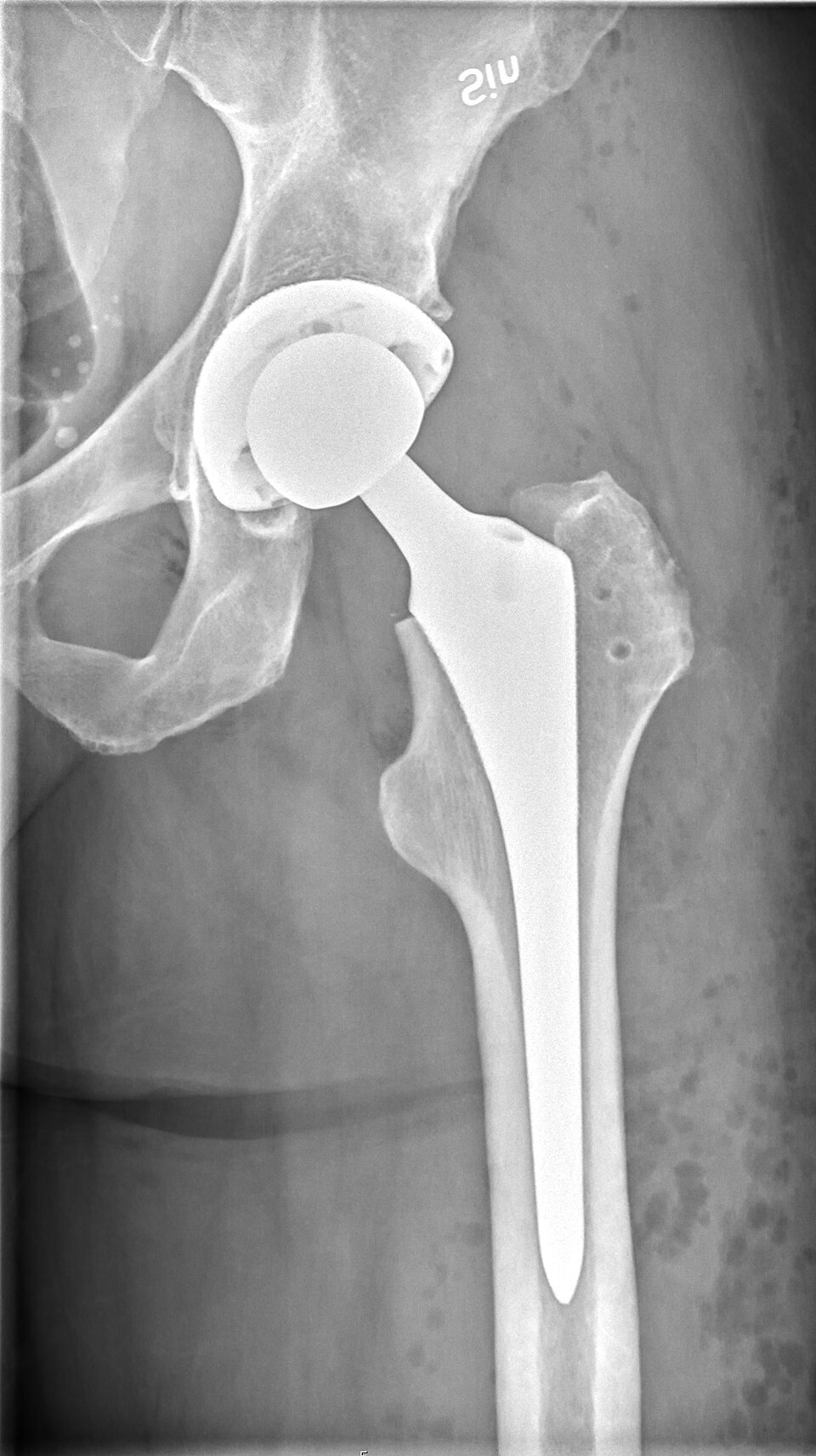 Post-operative AP hip radiograph after total hip arthroplasty (demo image).